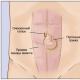 Hernia ombilicală la adulți Încălcarea simptomelor herniei ombilicale la un copil
